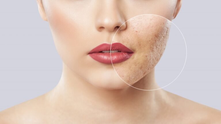 Dermatologist Tips For Acne Scar Removal