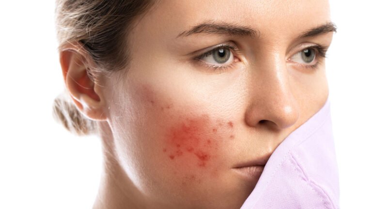 Folliculitis Treatment Fails: Hidden Reasons Your Skin Is not Improving